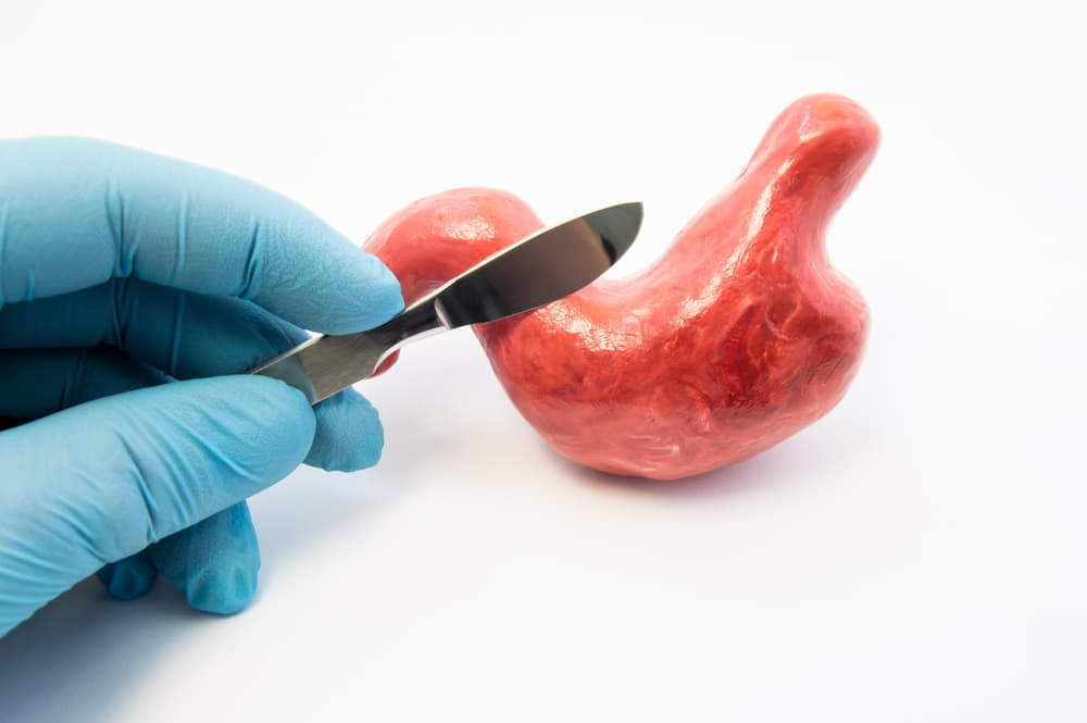 gastric sleeve surgery